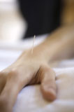 Close-up+of+a+human+hand+receiving+acupuncture+treatment