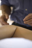 Close-up+of+a+person+receiving+acupuncture+treatment