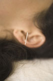 Close-up+of+a+woman+receiving+acupuncture+treatment
