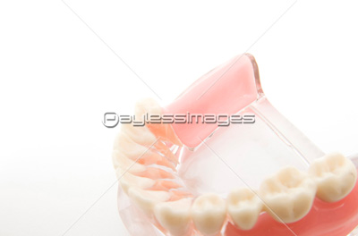 部分入歯の模型