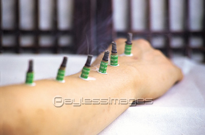 お灸をすえる手 ストックフォトの定額制ペイレスイメージズ