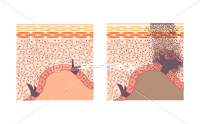 肌 皮膚 断面図 イラスト ストックフォトの定額制ペイレスイメージズ