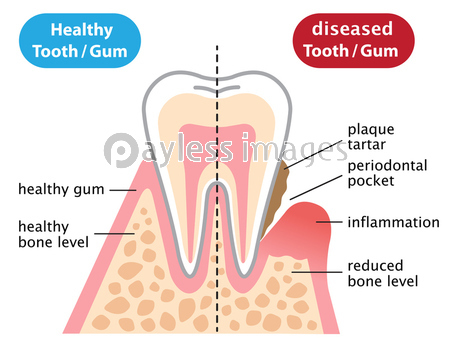 歯周病と健康な歯 断面図 ストックフォトの定額制ペイレスイメージズ