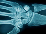 Hand+wrist+x-ray